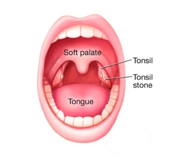 Close-up photo of mouth showing tonsil stones